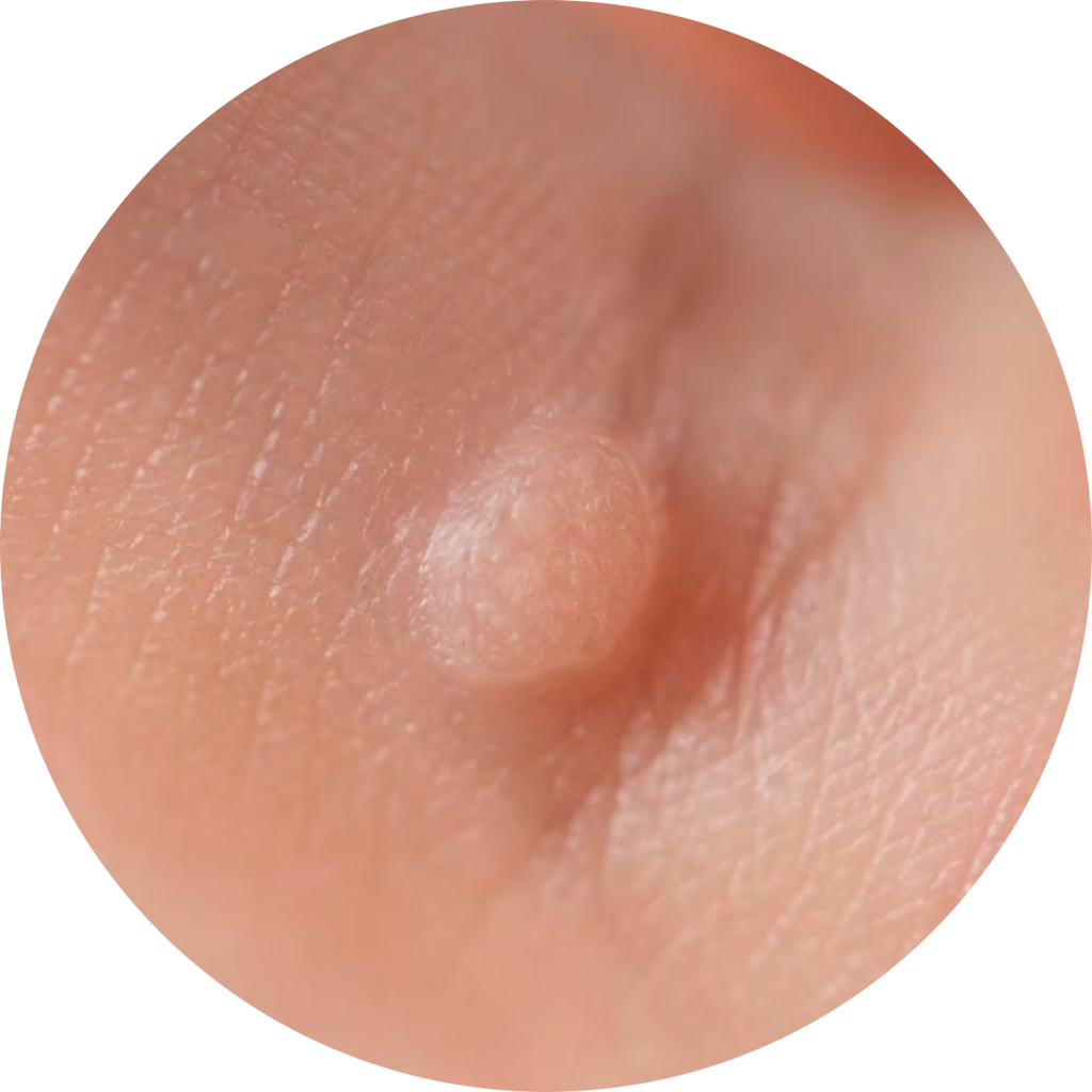 尋常疣
