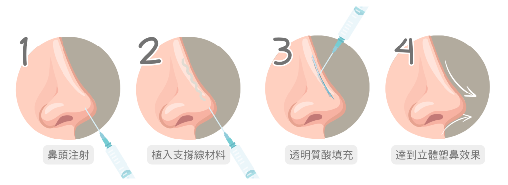 埋線鼻原理