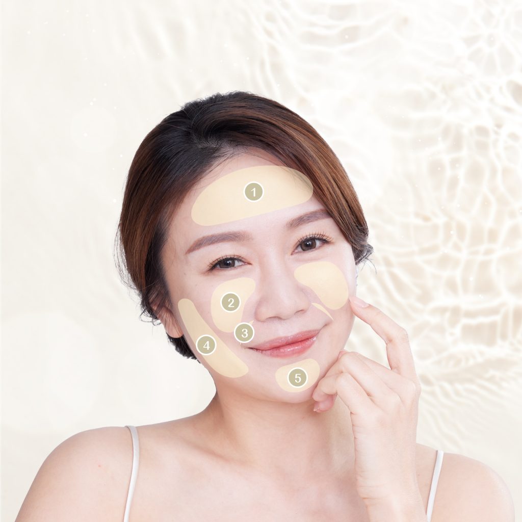 Juvéderm® Volift™適用位置