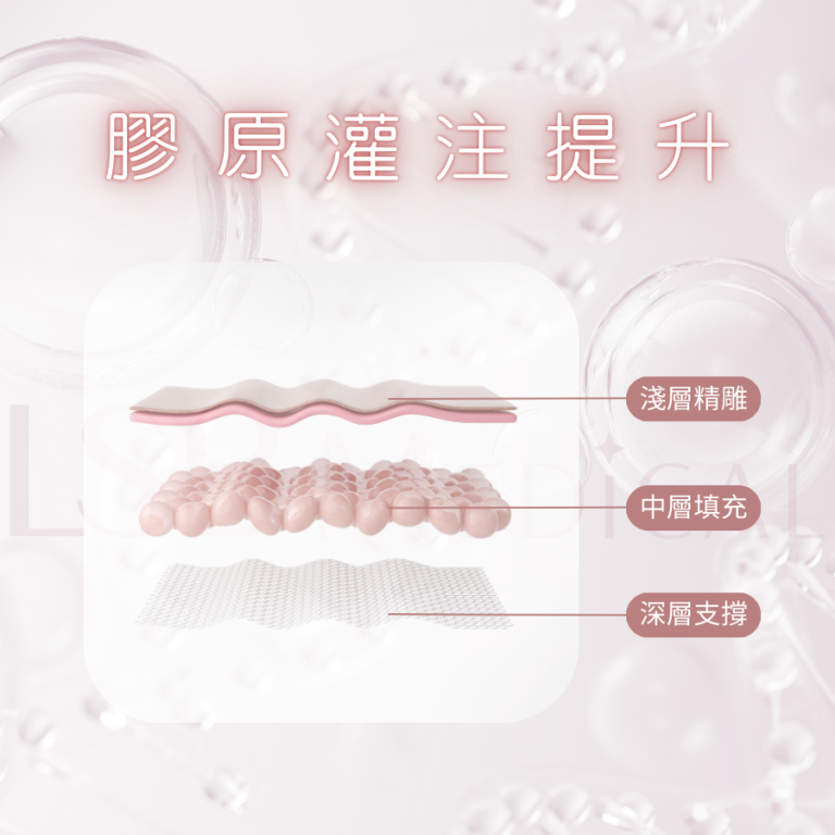 灌注提升